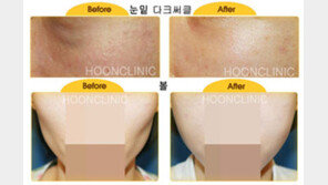 웨딩촬영 전, 체크해야 할 한 가지! - 자가지방이식