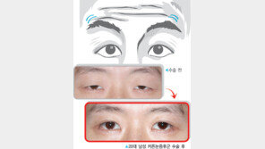 [건강]20대에 생긴 이마주름,주범은 ‘눈’