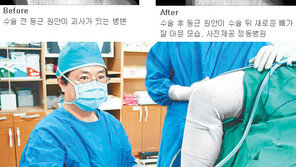 [헬스&뷰티/Before & After]거골 골괴사증 자가연골 이식