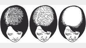 [헬스&뷰티]지나친 다이어트… 스트레스… 머리빠지는 여성 급증