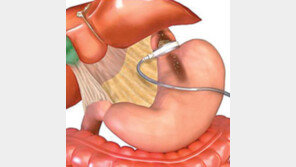 [헬스&뷰티]스웨디쉬 위밴드, 병원시술 가능
