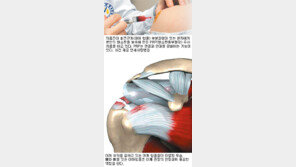 [헬스&뷰티]중년이후 어깨통증 80%는 오십견? 인대 염증-파열!