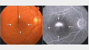 [헬스&뷰티]이성진 교수의 아이러브 eye