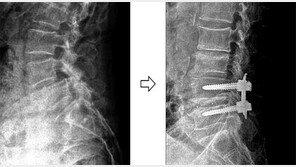 [헬스&뷰티/Before & After]척추관협착증