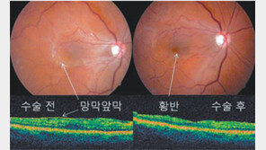[헬스&뷰티]이성진 교수의 아이러브 eye 