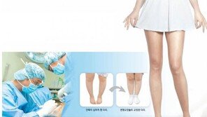 [헬스&뷰티] O형 휜 다리 이젠 손쉽게 쭉∼…“올여름엔 치마 입어야지”