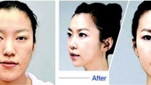 [헬스&뷰티/Before & After]턱뼈 교정수술