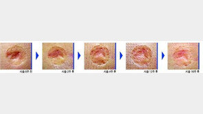 [헬스&뷰티/Before & After]자가섬유아세포 배양 시술