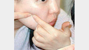 [헬스&뷰티]여드름, 손 대면 ‘분화구’ 늘어납니다