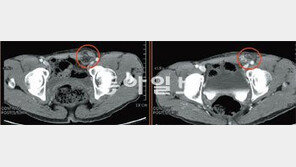 [헬스&뷰티/Before&After]회사원들의 ‘남모를 고민’ 탈장, 인공막 시술로 치료를