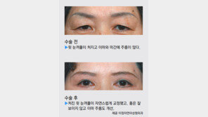 [헬스&뷰티]“눈 주변 처져 불편하시죠?