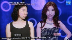 ‘렛미인’ 흔녀, 3580만 원 전신성형으로 ‘S라인 미인’
