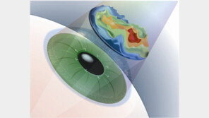 한 단계 진화한 라식수술, 아이라식 플러스