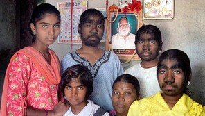 ‘늑대인간 증후군’ 세 자매 “우리도 결혼해서 행복하게”… 눈물!