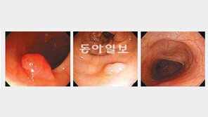 [헬스&뷰티]“대장내시경 후 안심은 3∼5년만… 정기검사 하세요”