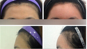 [이종승원장의 동안얼굴이야기] 볼록한 이마는 눈코의 균형을 잡아주는 효과까지 있다