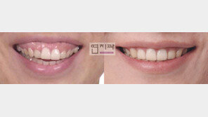 돌출입/거미스마일… 설측교정으로 양악수술 효과를?