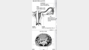 [여성 癌, 치료보다 예방이다] <3> ‘침묵의 암살자’ 난소암