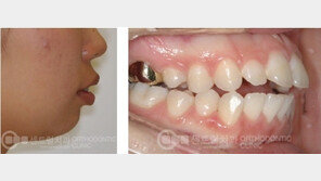 무조건적인 돌출입 수술 ‘금물’