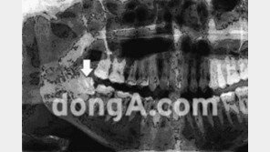 매복 사랑니 무조건 빼야할까?