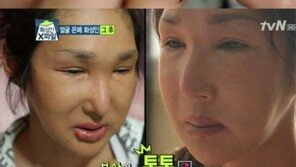 ‘얼굴 은폐녀’ 근황 “외모 놀랄 만큼 달라져, 남친과 식사도 가능”