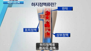 [뉴스A]‘울퉁불퉁’ 내 다리, 혹시 하지정맥류?
