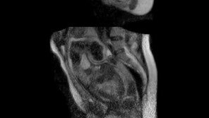 [영상] 출산 순간 MRI 영상 최초 공개