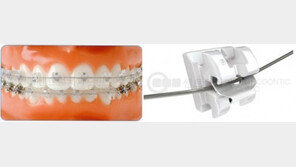 치아교정, 통증과 기간 걱정 없어도 된다?