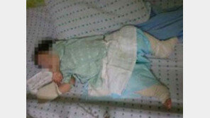 “어린이집에 맡겼다가”…2살 아기 끔찍한 화상