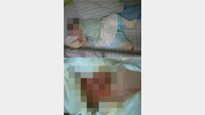 어린이집 화상 사고 “샤워기 온수에 이 정도 화상을?” 의혹 제기