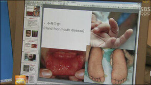 올해 첫 수족구병 사망자 발생…외출후 반드시 손 씻어야