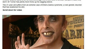 고무 피부 男, 희귀병으로 피부가 자유자재 ‘경악’