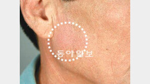 습한 여름철 지루피부염 극성… 과로 겹치면 만성질환 될수도