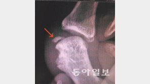 [런던 2012]부러진 손가락… 퉁퉁 부은 눈… 그래도 정신은 꺾이지 않았다