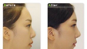 외모 콤플렉스 돌출입, 수술 없이 킬본돌출교정으로 끝!