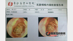 30대 여성 귓속에서 살아 있는 거미 발견 ‘충격’