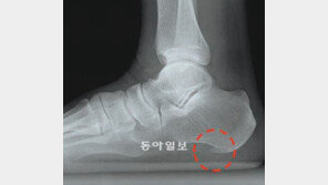 하이힐이 주는 벌 ‘발바닥 근막염’