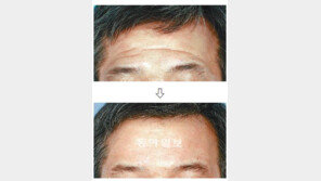 [헬스&뷰티]자연스러운 주름시술로 10년 더 젊게 산다
