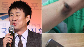 남희석, 아내 고데기 폭발사고 흉터 공개 “분하다”