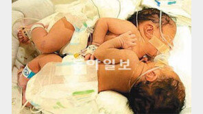 [TV 하이라이트]샴쌍둥이 출산과정 공개