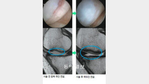 [헬스&뷰티/Before&After]연세사랑병원 연골재생술