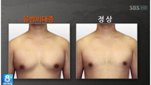 남성 유방 비대증 증가, 10대에게 두드러지는 이유는?
