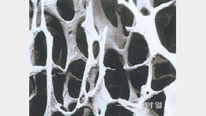 [헬스&뷰티/김재훈의 척추 이야기]<3> 골다공증 환자 괴롭히는 척추압박골절