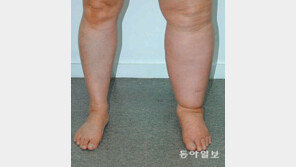 [헬스&뷰티]정맥순환장애-혈액순환장애, 차이점은?