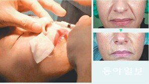[헬스&뷰티]100년 동안 진화 거듭한 필러, 오래가고 안전한 4세대 등장