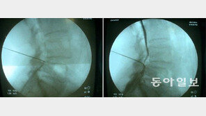 [헬스&뷰티]신경기능 회복으로 척추협착증 근본적 치료