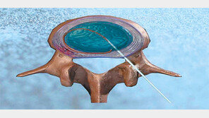 [헬스&뷰티]디스크 내장증 90% 이상은 수술없이 치료 가능