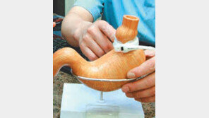 가수 신해철씨가 받았던 위밴드수술은… 비만 치료위해 위 자르는 대신 묶어