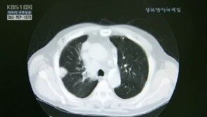 한국인 폐암 유형 1위 유전자 발견… 폐암 정복 초읽기?