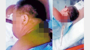 나무막대가 얼굴 관통했지만…40대 男, 기적적으로 생존